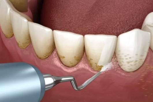 scaling and root planing cost scaling and root planing cost