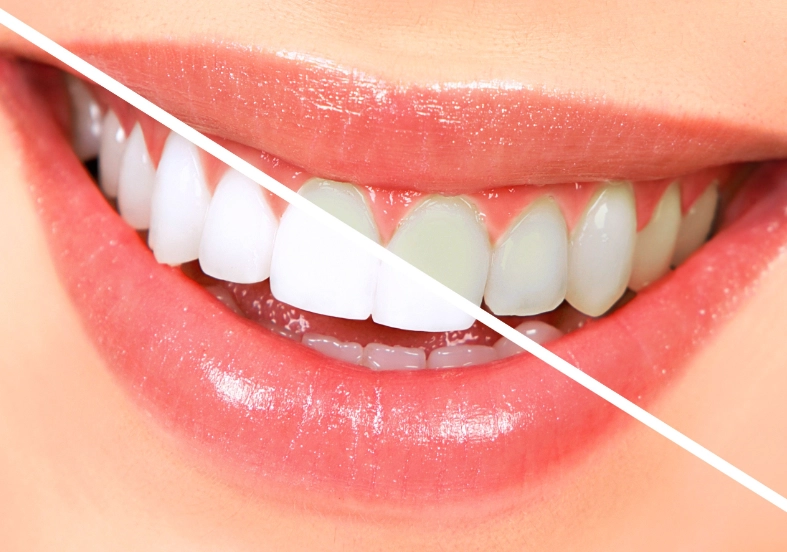 teeth whitening results teeth whitening results
