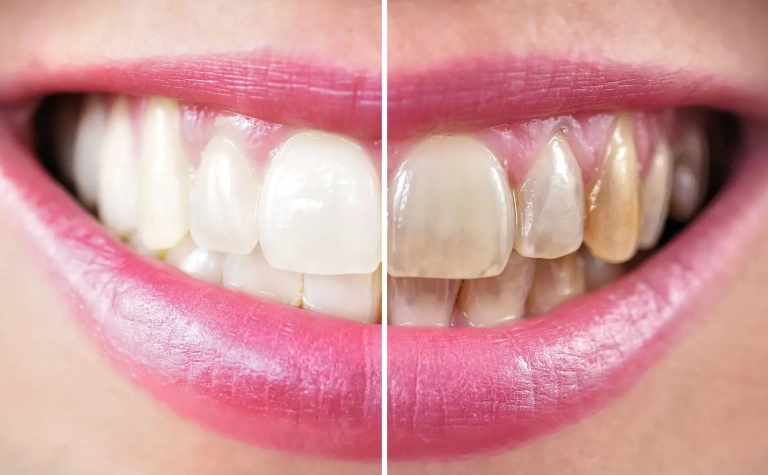 how long does teeth whitening last how long does teeth whitening last