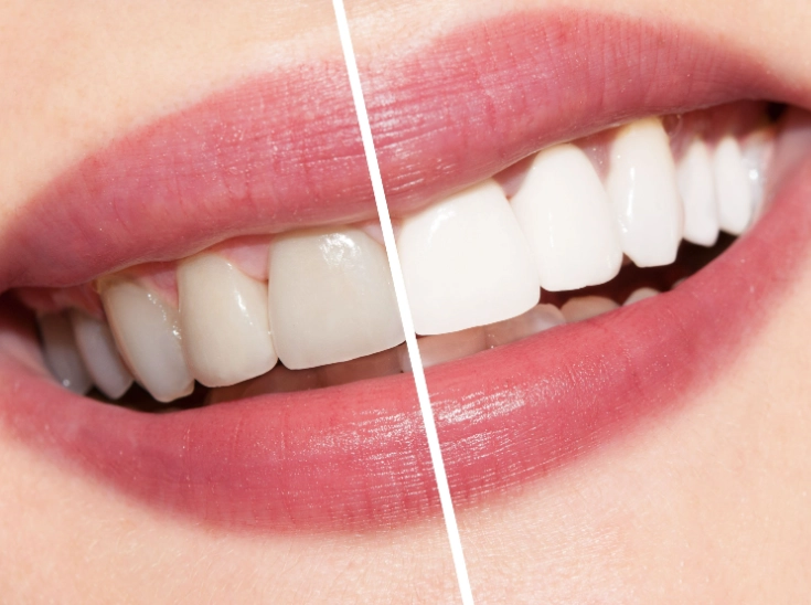 teeth whitening results teeth whitening results