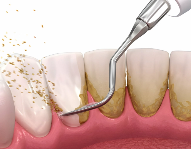 deep cleaning teeth cost deep cleaning teeth cost