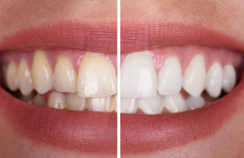 best teeth whitening products best teeth whitening products