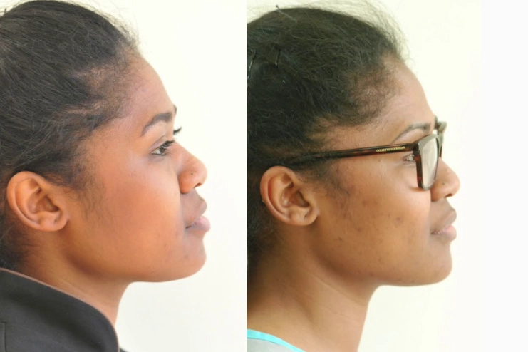 facial structure after wisdom teeth extraction