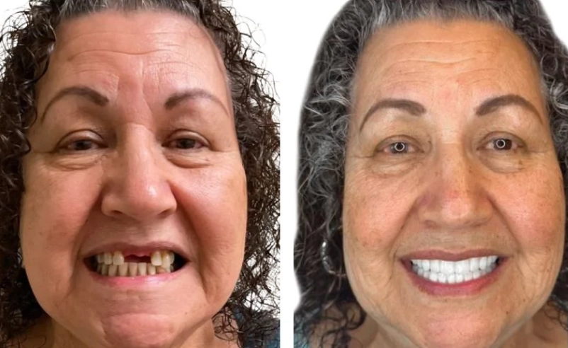 wisdom teeth removal effects on face