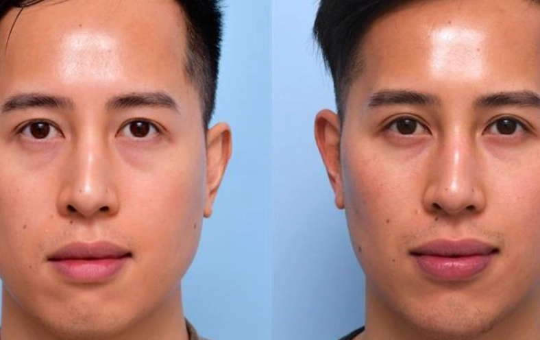 wisdom teeth removal effects on face