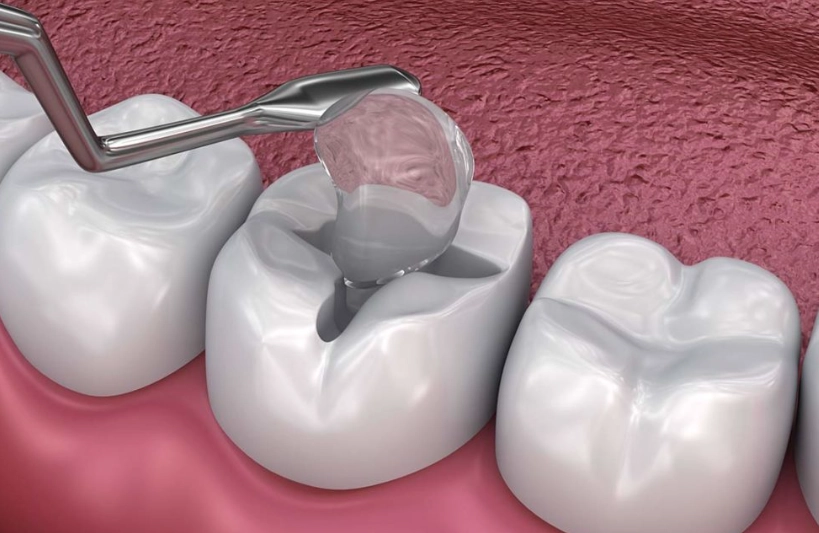 tooth filling procedure