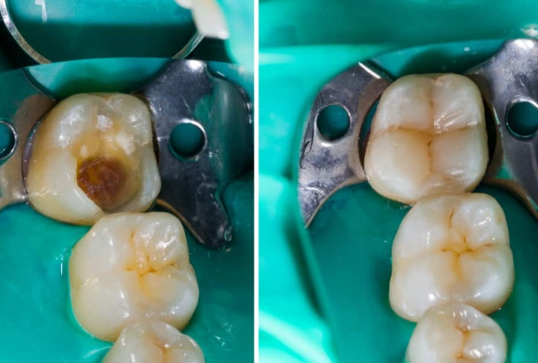 tooth filling procedure