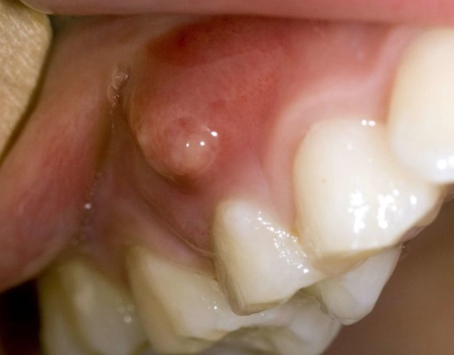 tooth abscess home remedy