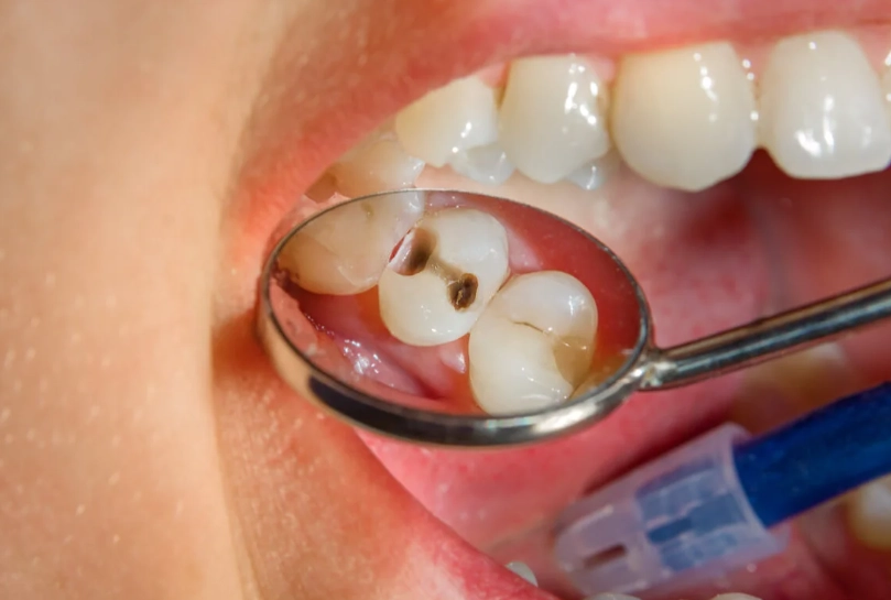 cavity filling