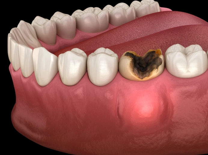 abscess tooth pain relief