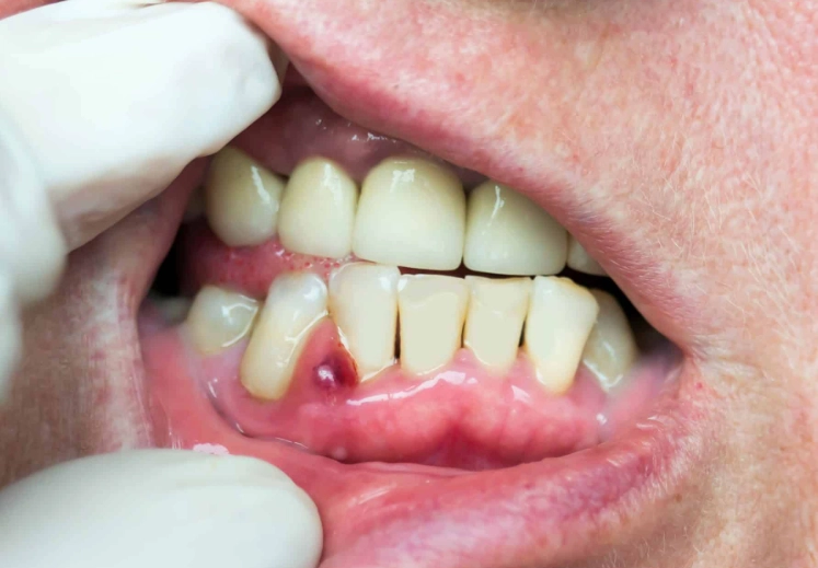 tooth abscess home remedy