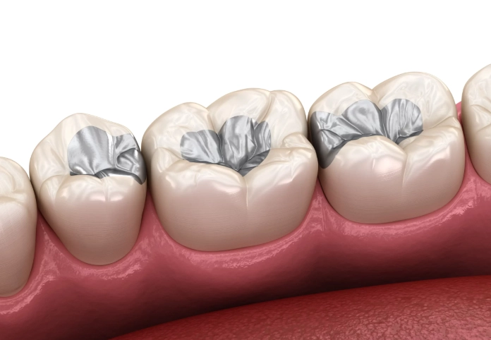 tooth filling procedure