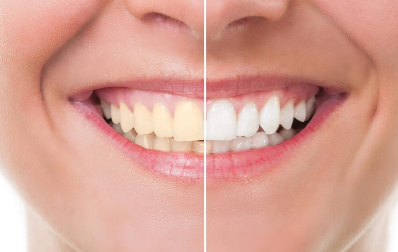 how to whiten teeth naturally