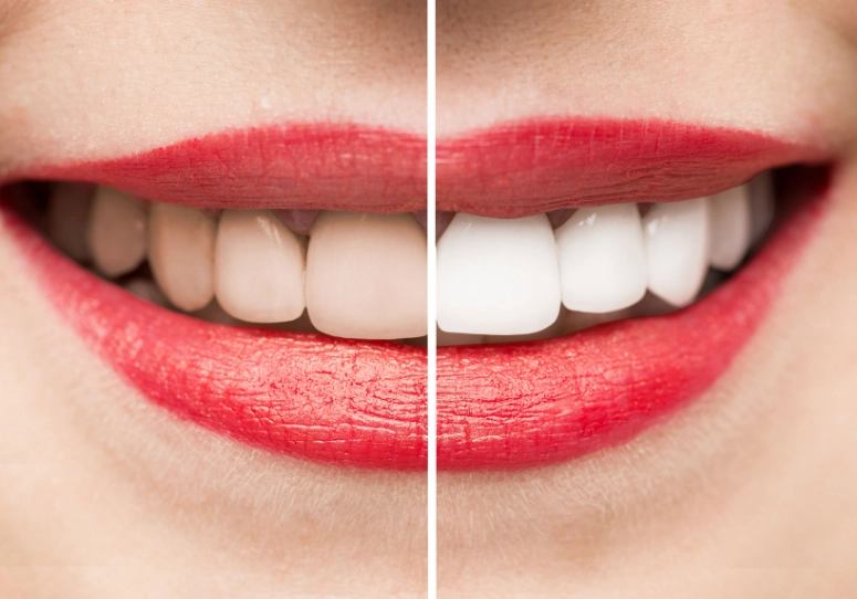 teeth whitening reviews teeth whitening reviews