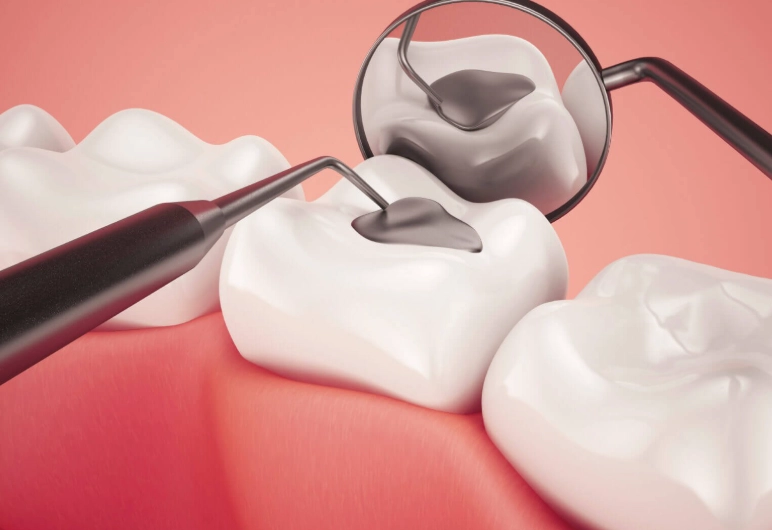 tooth filling procedure