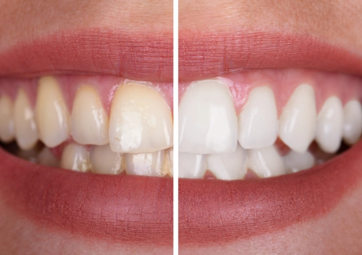 how to whiten teeth naturally