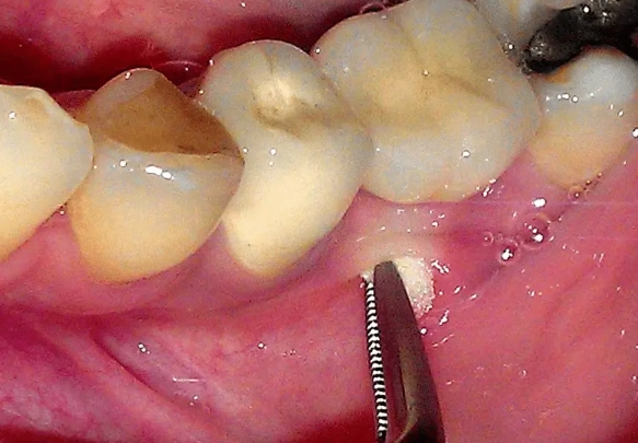tooth root infection