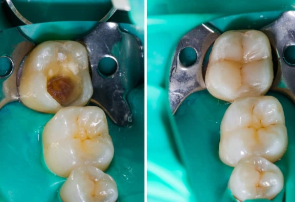 tooth filling procedure