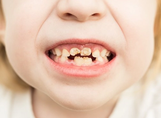 baby bottle tooth decay