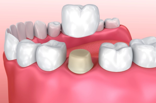 dental cement failure