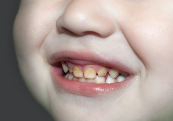 infant dental caries