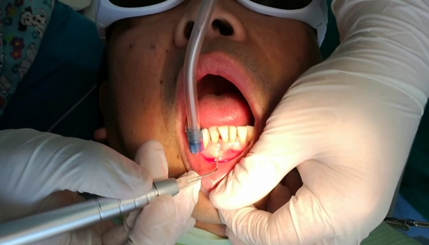 dental abscess symptoms