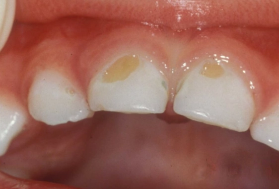 milk rot teeth prevention