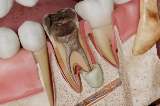 tooth root infection
