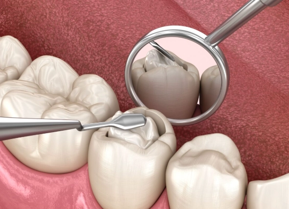 tooth filling procedure