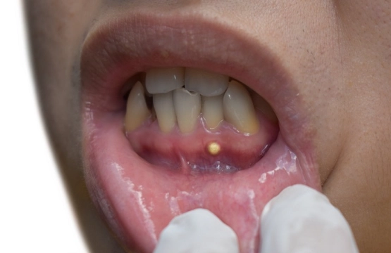 dental abscess symptoms