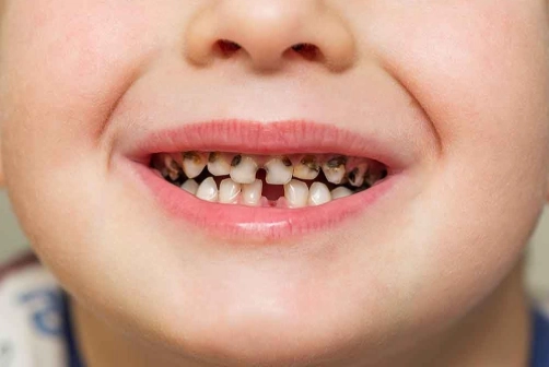infant dental caries