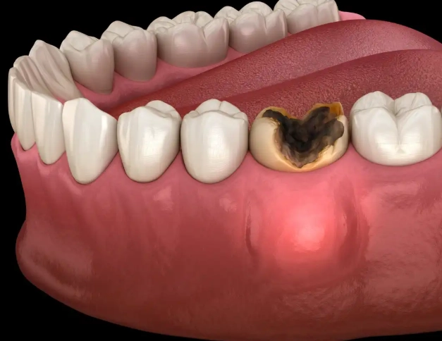 abscessed tooth treatment