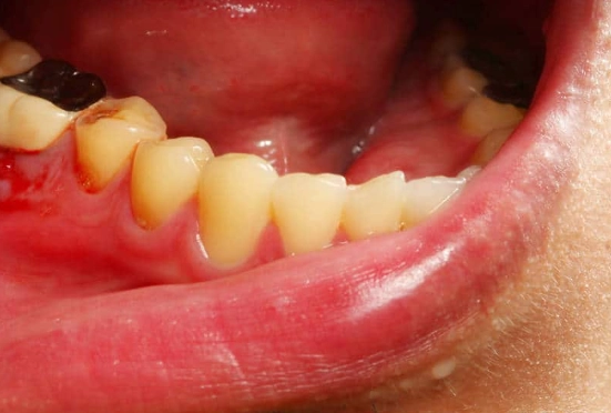 dental abscess pain relief