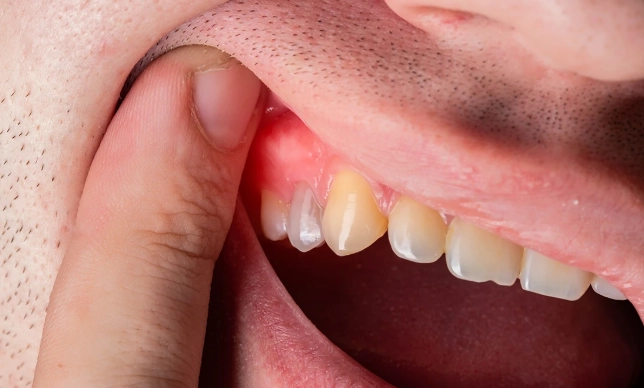 what cause dental abscess