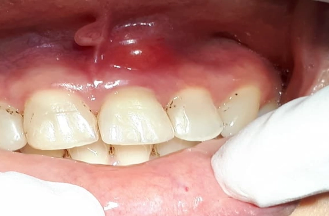 root canal abscess