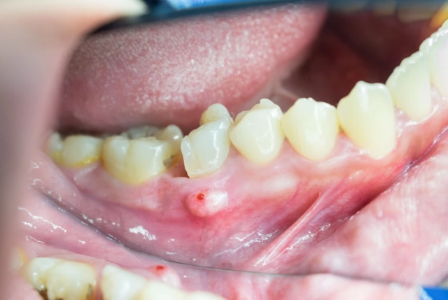 dental abscess pain relief