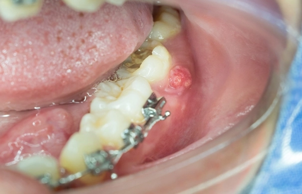 tooth infection causes