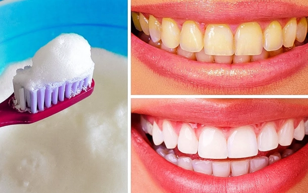 home teeth whitening