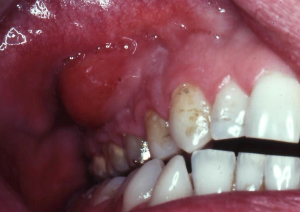 dental abscess causes
