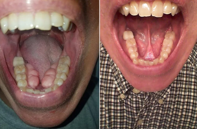 palatal tori palatal tori