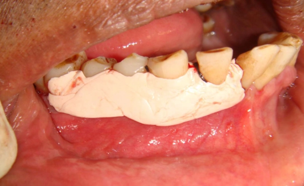 tori mandibularis tori mandibularis