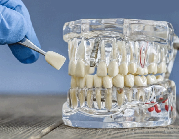 tori mandibularis tori mandibularis