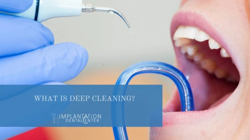 deep cleaning teeth