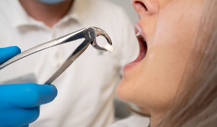 extraction of tooth broken at gum line