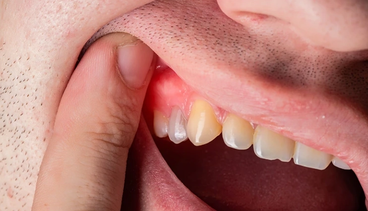 can a dentist pull a broken tooth at gum line