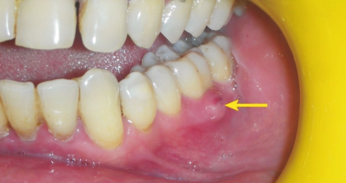 dental abscess symptoms