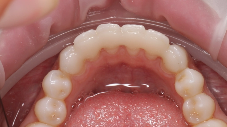 when to replace teeth retainer