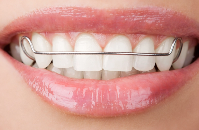 when to replace teeth retainer