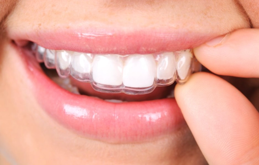 retainer replacement schedule