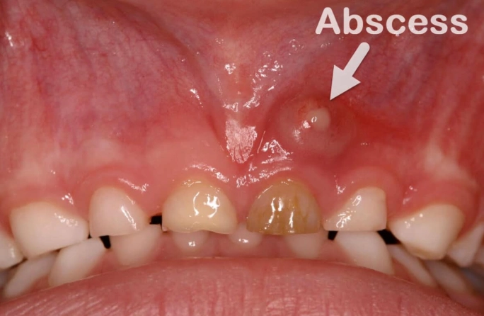 dental abscess symptoms